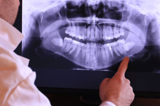 Best Emergency Treatment for Dental Infections or Abscesses in Manche North Shore, CA