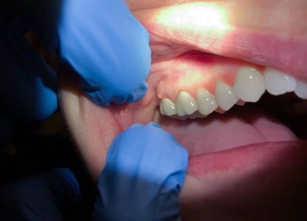 Best Urgent Care for Lost Fillings or Crowns in Manche North Shore, CA